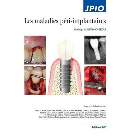 Les maladies péri-implantaires