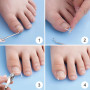 Correction Des Ongles Des Orteils - Correction Des Ongles Des Orteils Incarnés