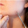 Blackhead Remov