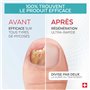 PODERM - MYCOSE ONGLES BOOSTER DE TRAITEMENT pour mycose difficile à traiter | Divise par 2 la durée du Traitement | Soin profes