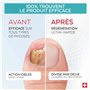 PODERM - LOT MYCOSE ONGLE SEVÈRE 2 PRODUITS | 2 Best Sellers | Traitement complet spécial Mycose difficile à traiter | Soin prof