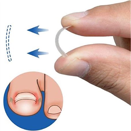 Young21 Clip De Redressement D'Ongle Incarné Outil De Correction De Paronychie Épaisse BS Brace Toenails