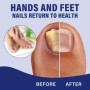 30ml Professionnel Soin D’ongle, Mycose de l'ongle,Pour Les Ongles Décolorés Épaissis,Contre la Mycose de l'ongle Persistante, A
