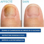 ADDAX - MYCOFLASH® - Stylo de traitement pour mycoses des ongles - Action Rapide 20s* - Antifongique Ongles Pieds & Mains - 5ml